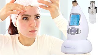 Microderm Glo Review amp How To Use  Microdermabrasion DIY Facial Treatment For Clear Skin [upl. by Aitel]