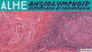 ALHE Angiolymphoid Hyperplasia with Eosinophilia 5Minute Pathology Pearls [upl. by Nedrud]