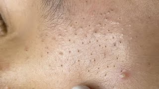 Satisfying Relaxing with Sac Dep Spa Video 087 acne [upl. by Ielirol993]