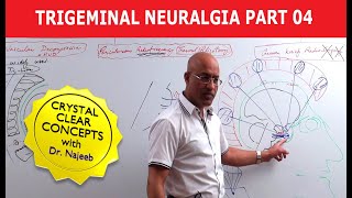 Trigeminal Neuralgia  Causes and Treatment  Part 4 [upl. by Hajin]