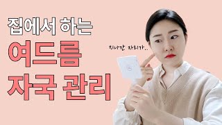 여드름 자국 없애는 방법 히루스카 여드름 자국 연고 [upl. by Nerha]