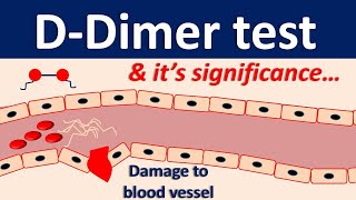 Ddimer test and its significance [upl. by Sacrod]