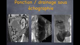 Pancréatite aiguë  3 Diagnostic des complications [upl. by Palm643]