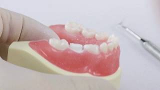 Pediatric Zirconia Crown Technique  Posterior [upl. by Misti]