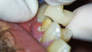 Dental Crown EXPLAINED and how much Tooth Youll Lose [upl. by Moshell]