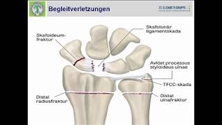 0716  Begleitverletzungen der distalen Radiusfraktur [upl. by Veradia477]