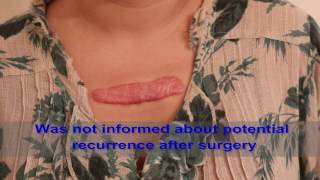 Chest Keloids  Mistakes to Avoid [upl. by Leseil]