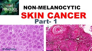 SKIN CANCER Non Melanocytic Part 1 Anatomy Etiopathogenesis amp Classification [upl. by Inilam]