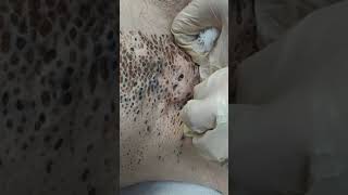 Nevus Comedonicus removal [upl. by Krys]