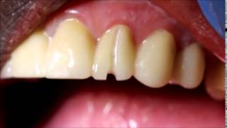 How to remove a zirconia crown [upl. by Fronia]