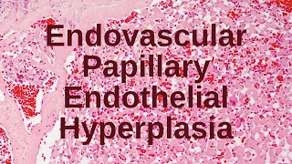 Endovascular Papillary Endothelial Hyperplasia  Pathology mini tutorial [upl. by Beuthel972]