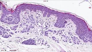 Compound Melanocytic Nevus  Histopathology [upl. by Ived85]