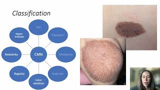 Publication Presentation Care of Congenital Melanocytic Nevi in Newborns and Infants [upl. by Keyser244]