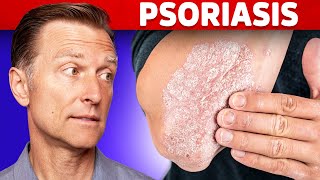 Psoriasis Treatment – The Best 3 Remedies for Psoriasis – DrBerg [upl. by Euh]