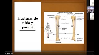 FRACTURA DE TIBÍA Y PERONÉ [upl. by Ziladnerb509]