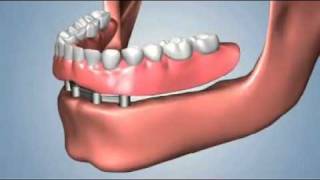 edentulismo completo opciones fija total sobredentaduraflv [upl. by Mahoney]