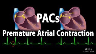 Premature Atrial Contractions PACs Animation [upl. by Deevan390]