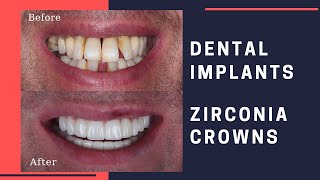 Dental Implants amp Zirconia Crowns Patient Review [upl. by Tarah]