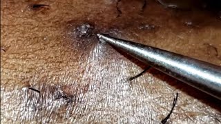 INGROWN HAIR REMOVAL 13 [upl. by Rockwood]