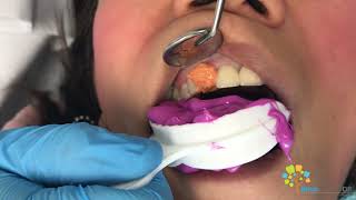 Cosmetic Dental Crown Procedure  All Ceramic Crown [upl. by Oraneg]